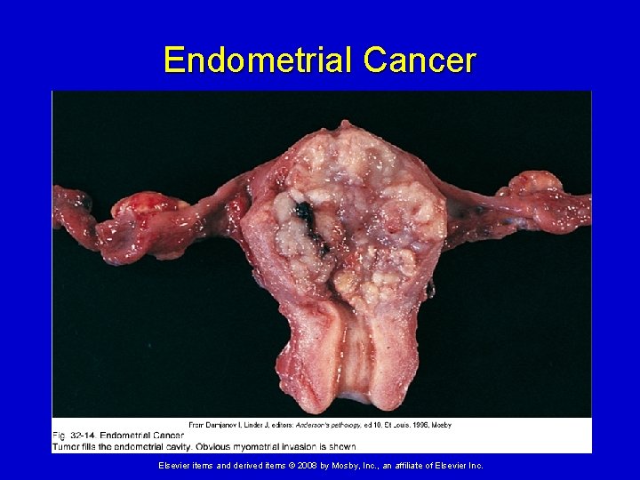 Endometrial Cancer Elsevier items and derived items © 2008 by Mosby, Inc. , an