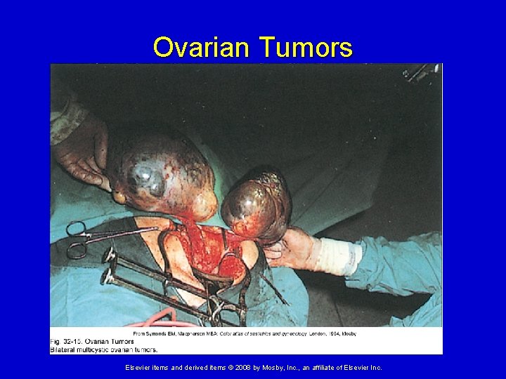 Ovarian Tumors Elsevier items and derived items © 2008 by Mosby, Inc. , an