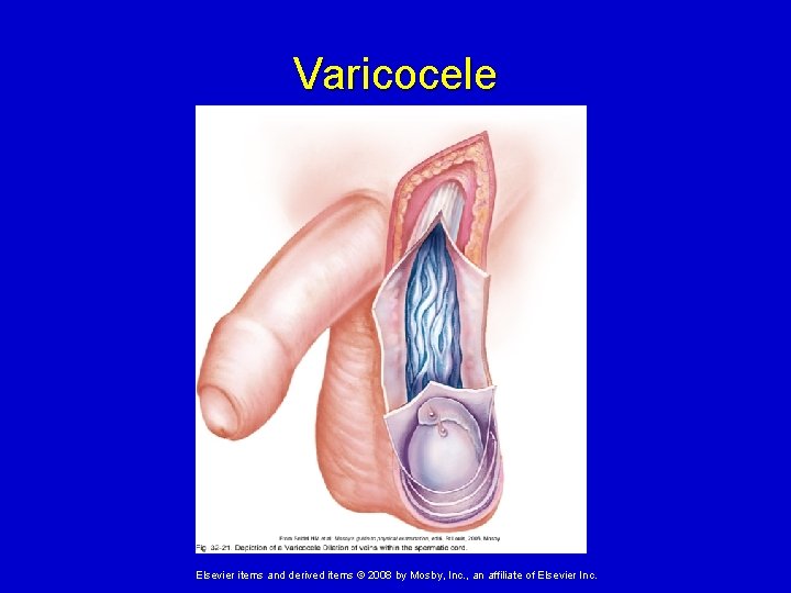 Varicocele Elsevier items and derived items © 2008 by Mosby, Inc. , an affiliate