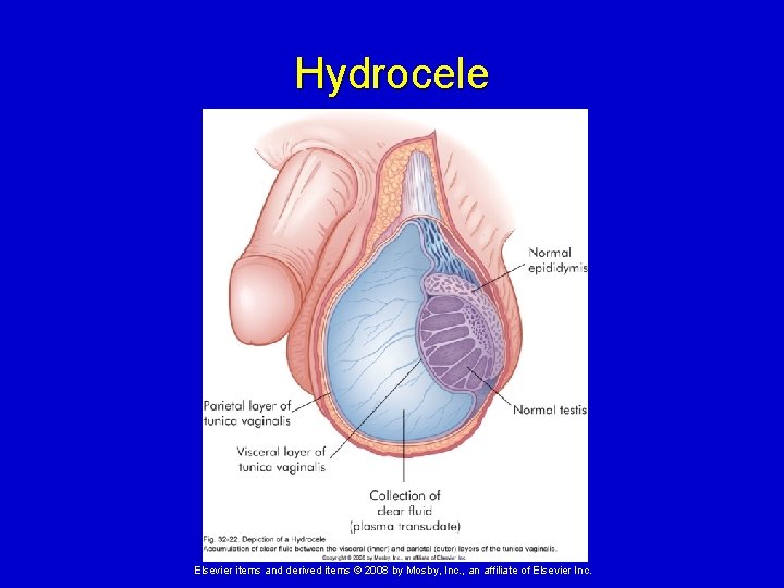 Hydrocele Elsevier items and derived items © 2008 by Mosby, Inc. , an affiliate