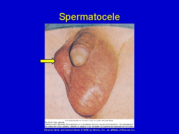 Spermatocele Elsevier items and derived items © 2008 by Mosby, Inc. , an affiliate