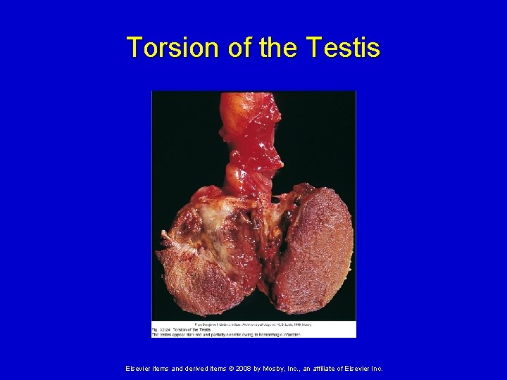 Torsion of the Testis Elsevier items and derived items © 2008 by Mosby, Inc.