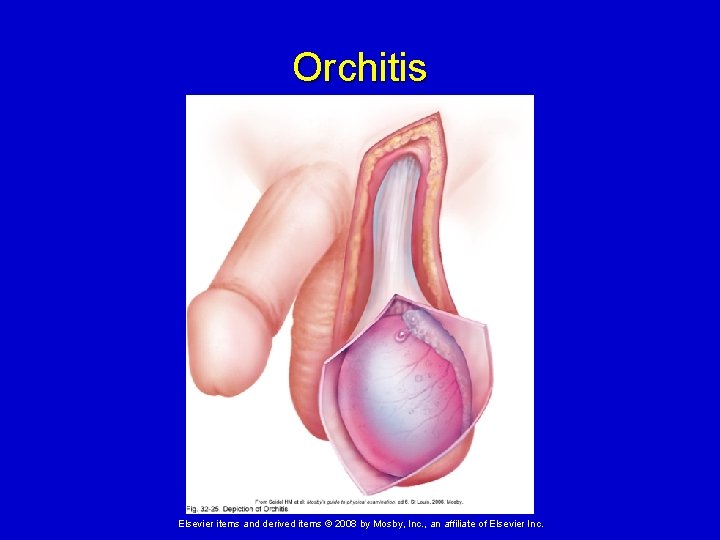 Orchitis Elsevier items and derived items © 2008 by Mosby, Inc. , an affiliate