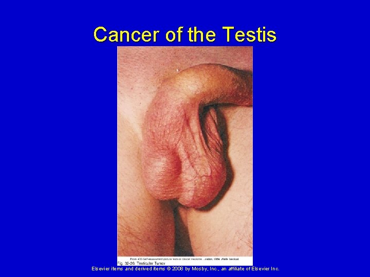 Cancer of the Testis Elsevier items and derived items © 2008 by Mosby, Inc.