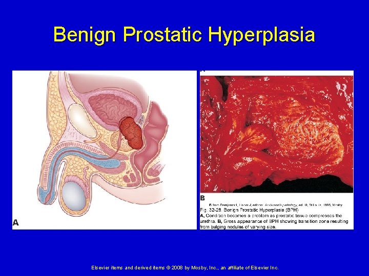 Benign Prostatic Hyperplasia Elsevier items and derived items © 2008 by Mosby, Inc. ,