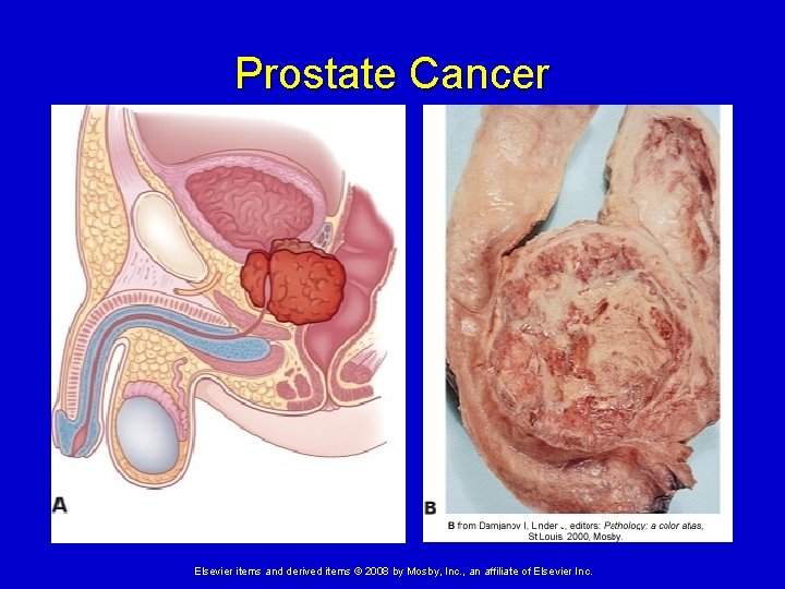 Prostate Cancer Elsevier items and derived items © 2008 by Mosby, Inc. , an