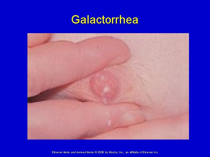 Galactorrhea Elsevier items and derived items © 2008 by Mosby, Inc. , an affiliate