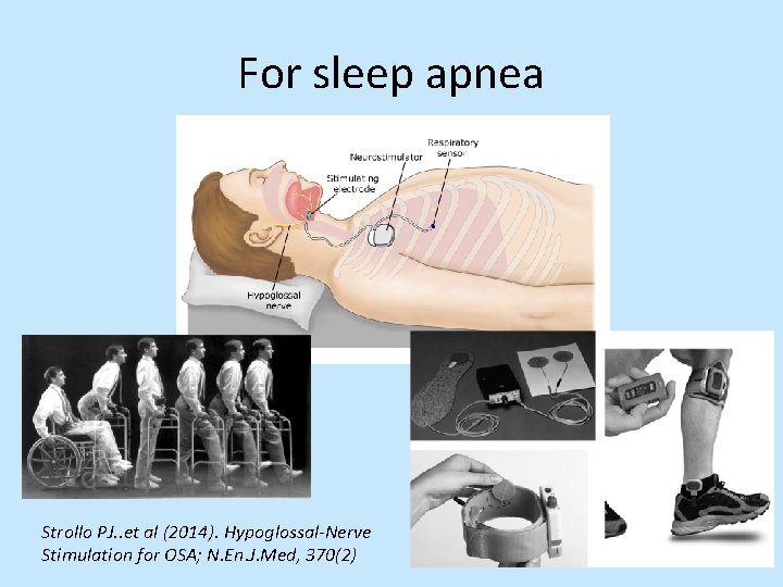 For sleep apnea Strollo PJ. . et al (2014). Hypoglossal-Nerve Stimulation for OSA; N.