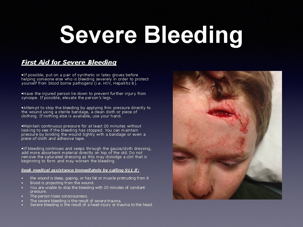 Severe Bleeding First Aid for Severe Bleeding • If possible, put on a pair