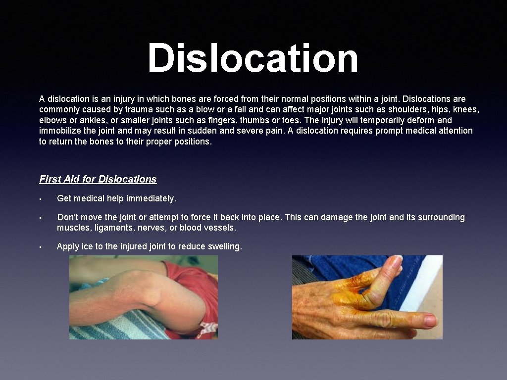 Dislocation A dislocation is an injury in which bones are forced from their normal