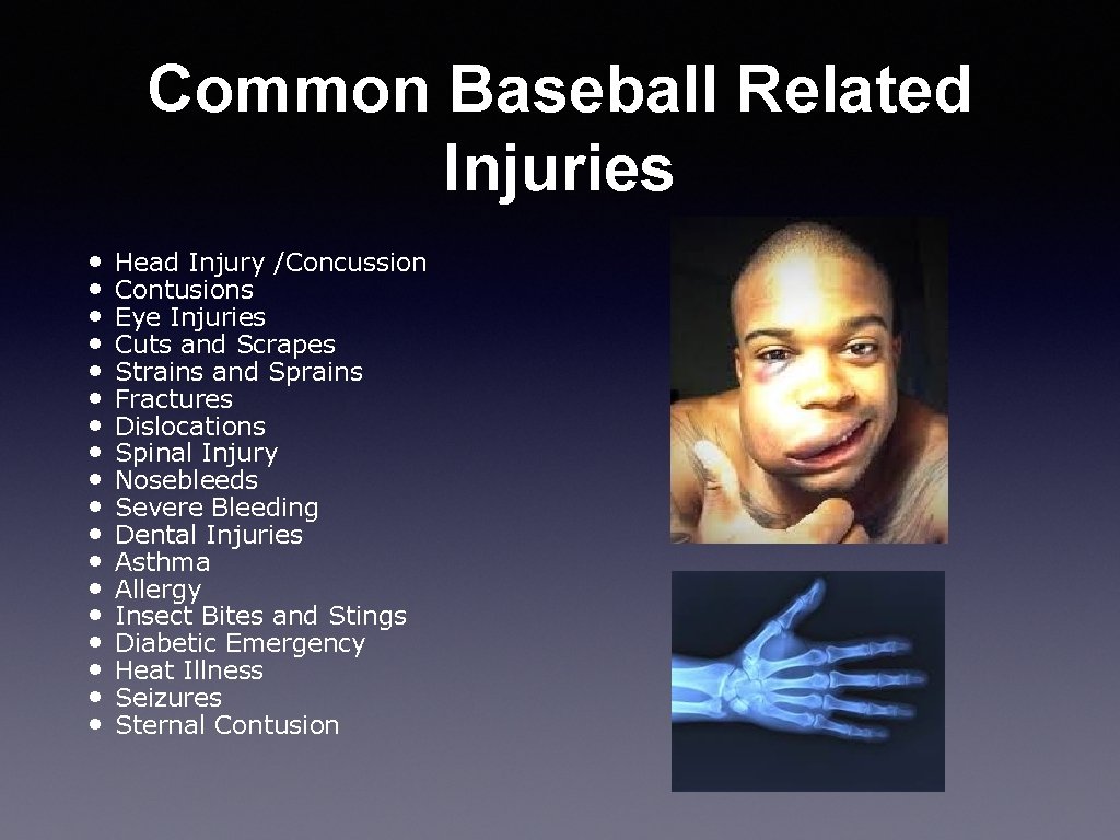 Common Baseball Related Injuries • • • • • Head Injury /Concussion Contusions Eye