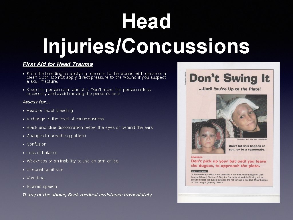 Head Injuries/Concussions First Aid for Head Trauma • Stop the bleeding by applying pressure