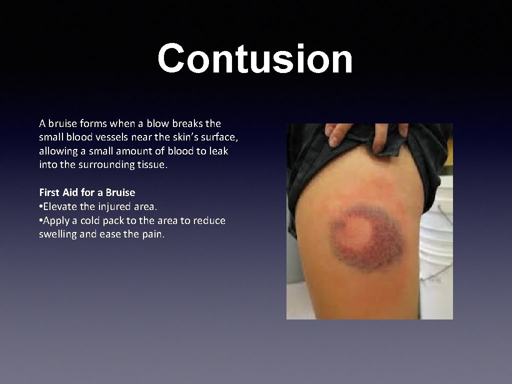 Contusion A bruise forms when a blow breaks the small blood vessels near the