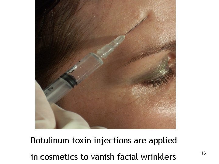Botulinum toxin injections are applied in cosmetics to vanish facial wrinklers 16 