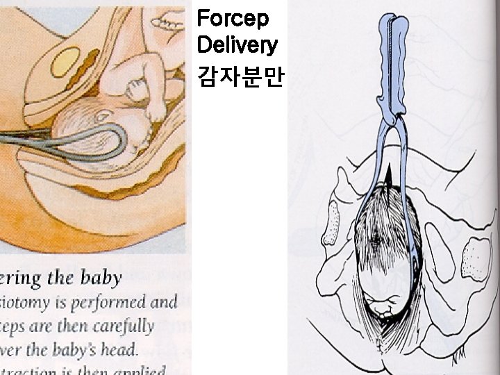 Forcep Delivery 감자분만 