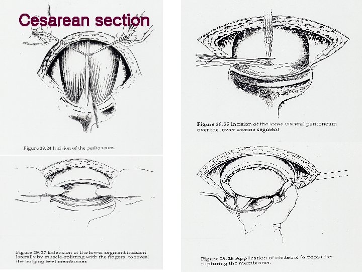 Cesarean section 