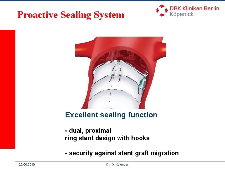 12 Proactive Sealing System Excellent sealing function - dual, proximal ring stent design with