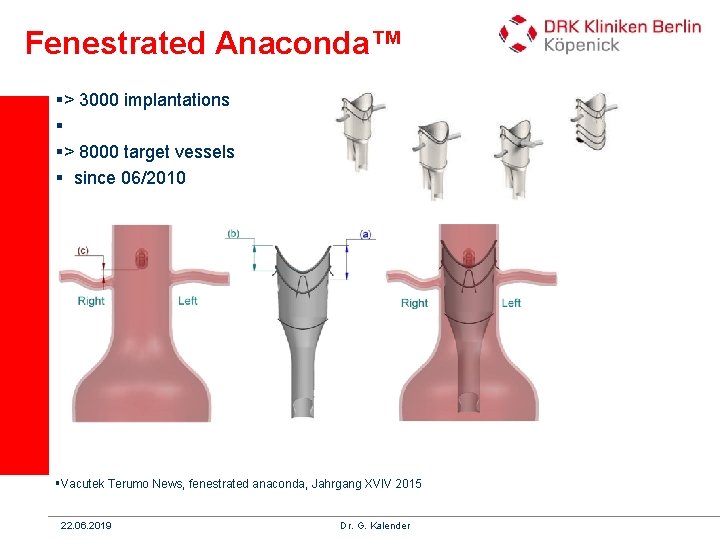 Fenestrated Anaconda™ §> 3000 implantations § §> 8000 target vessels § since 06/2010 §Vacutek