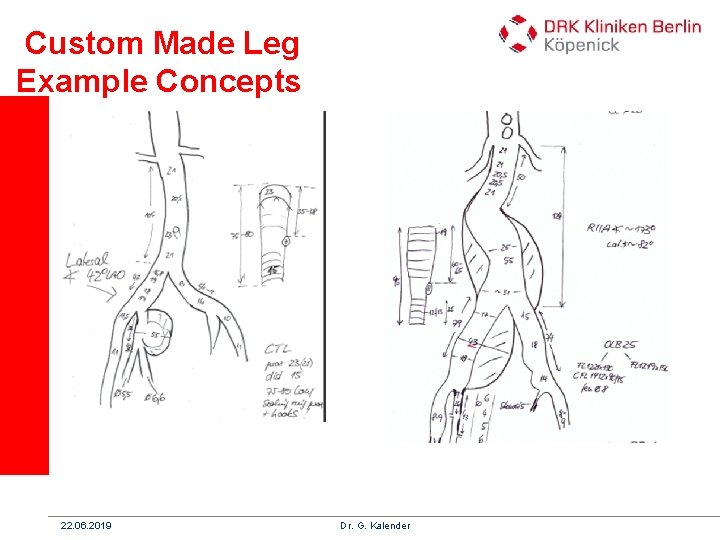 Custom Made Leg Example Concepts 22. 06. 2019 Dr. G. Kalender 