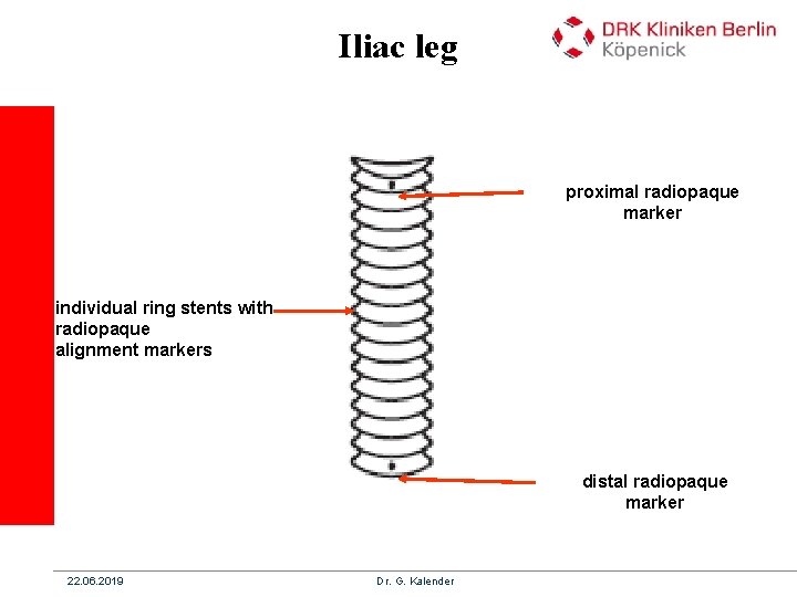 Iliac leg proximal radiopaque marker individual ring stents with radiopaque alignment markers distal radiopaque