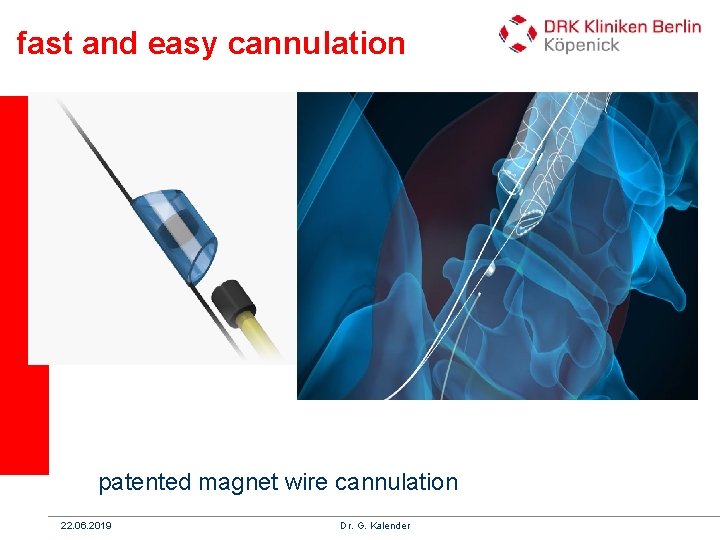 fast and easy cannulation patented magnet wire cannulation 22. 06. 2019 Dr. G. Kalender