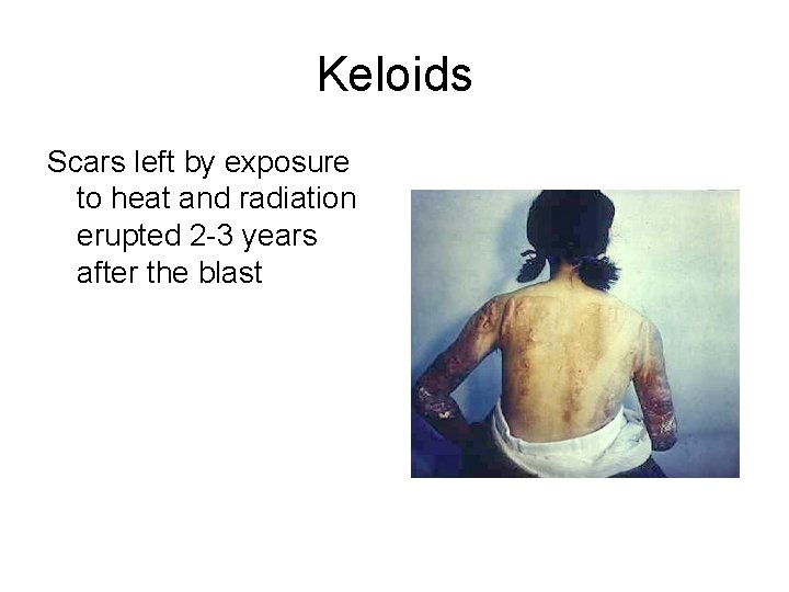 Keloids Scars left by exposure to heat and radiation erupted 2 -3 years after