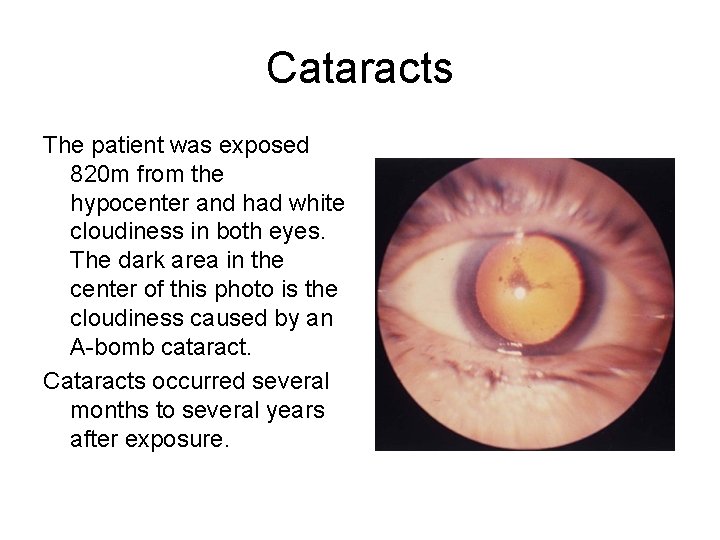 Cataracts The patient was exposed 820 m from the hypocenter and had white cloudiness