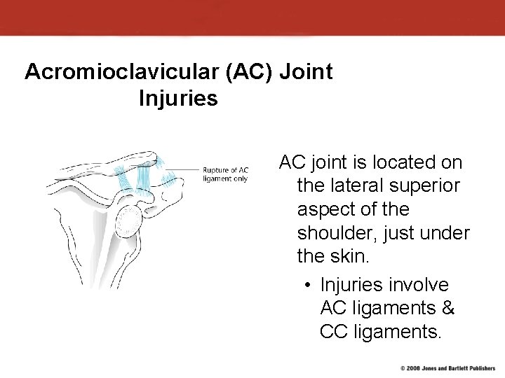 Acromioclavicular (AC) Joint Injuries AC joint is located on the lateral superior aspect of Acromioclavicular (AC) Joint Injuries AC joint is located on the lateral superior aspect of