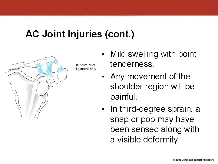AC Joint Injuries (cont. ) • Mild swelling with point tenderness. • Any movement AC Joint Injuries (cont. ) • Mild swelling with point tenderness. • Any movement