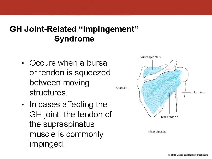 GH Joint-Related “Impingement” Syndrome • Occurs when a bursa or tendon is squeezed between GH Joint-Related “Impingement” Syndrome • Occurs when a bursa or tendon is squeezed between