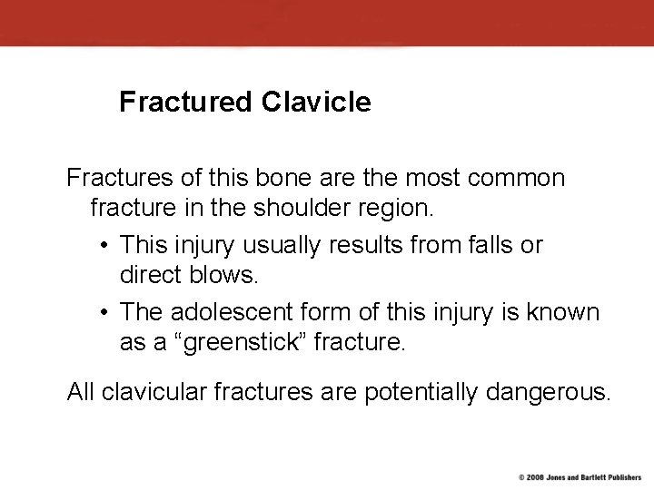 Fractured Clavicle Fractures of this bone are the most common fracture in the shoulder Fractured Clavicle Fractures of this bone are the most common fracture in the shoulder