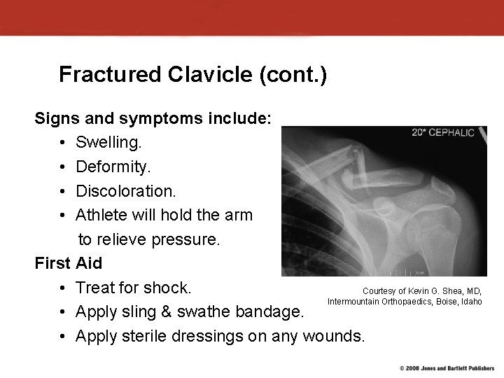 Fractured Clavicle (cont. ) Signs and symptoms include: • Swelling. • Deformity. • Discoloration. Fractured Clavicle (cont. ) Signs and symptoms include: • Swelling. • Deformity. • Discoloration.