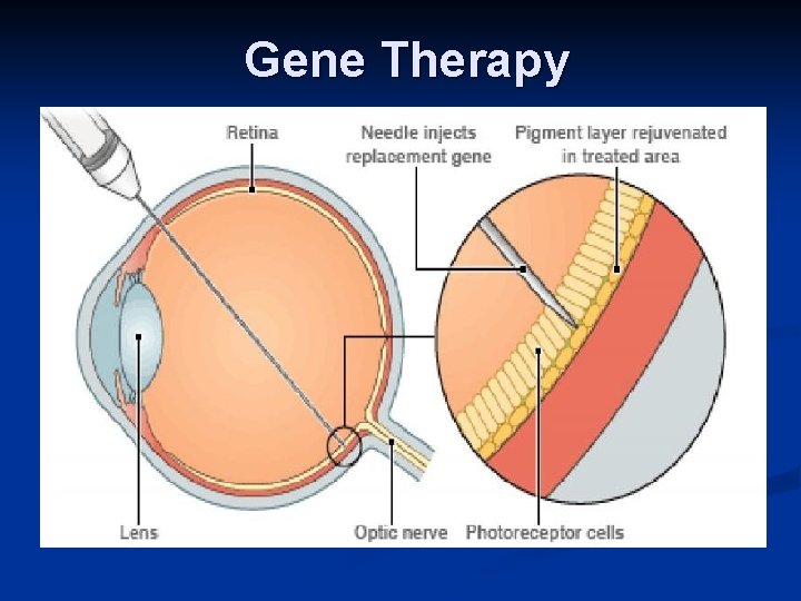 Gene Therapy 