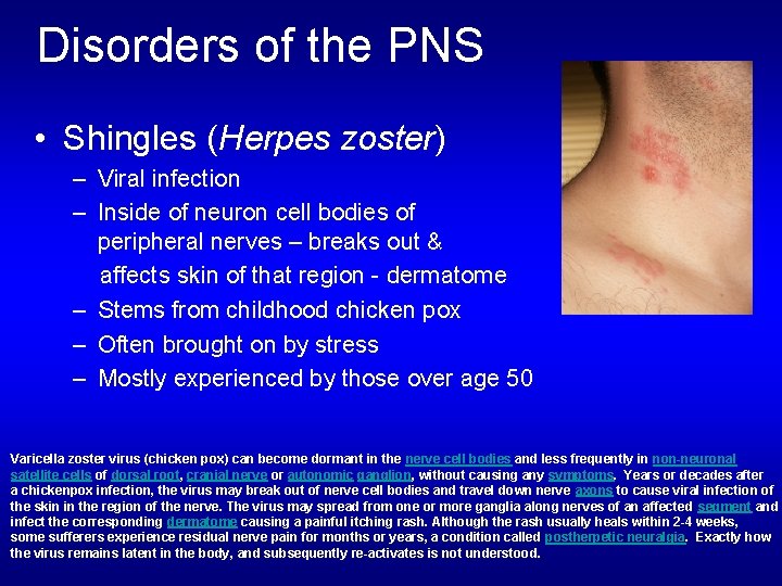 Disorders of the PNS • Shingles (Herpes zoster) – Viral infection – Inside of