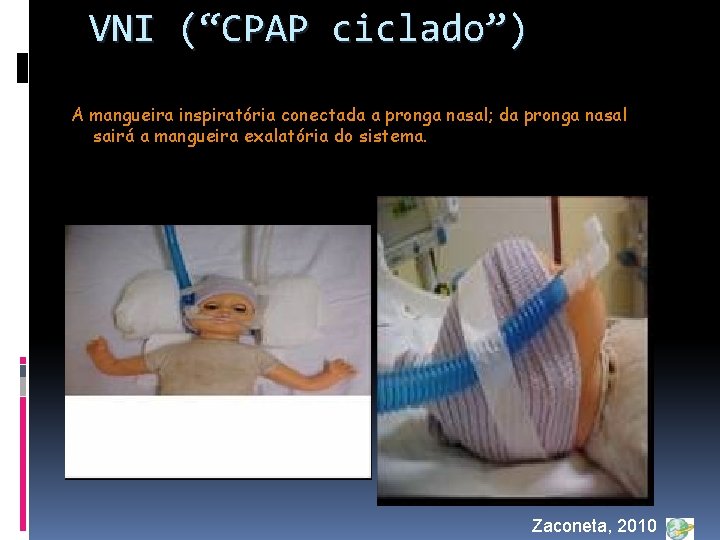 VNI (“CPAP ciclado”) A mangueira inspiratória conectada a pronga nasal; da pronga nasal sairá