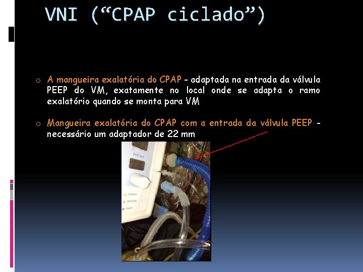 VNI (“CPAP ciclado”) o A mangueira exalatória do CPAP - adaptada na entrada da