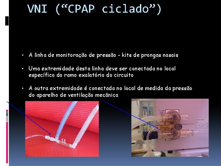 VNI (“CPAP ciclado”) • A linha de monitoração de pressão - kits de prongas