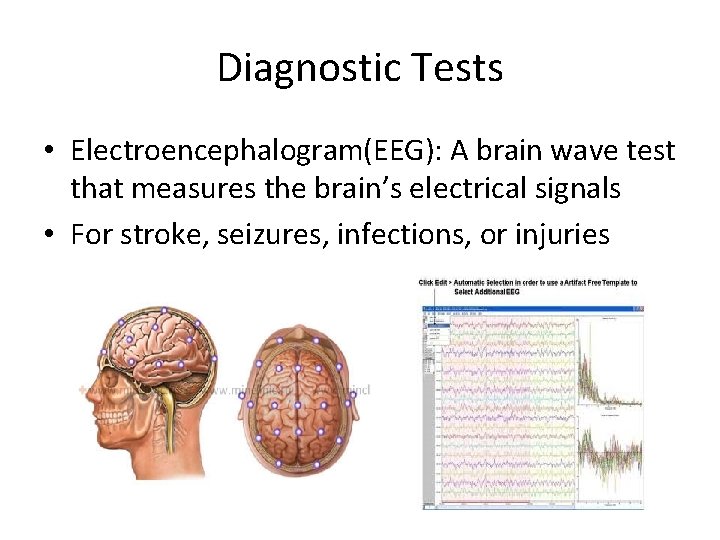 Diagnostic Tests • Electroencephalogram(EEG): A brain wave test that measures the brain’s electrical signals