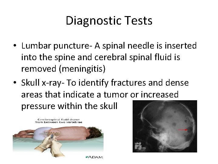 Diagnostic Tests • Lumbar puncture- A spinal needle is inserted into the spine and