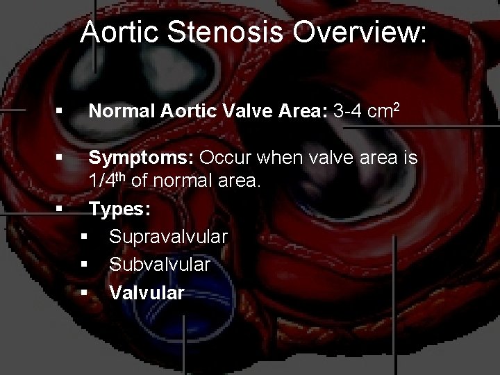 Aortic Stenosis Overview: § § Normal Aortic Valve Area: 3 -4 cm 2 Symptoms: