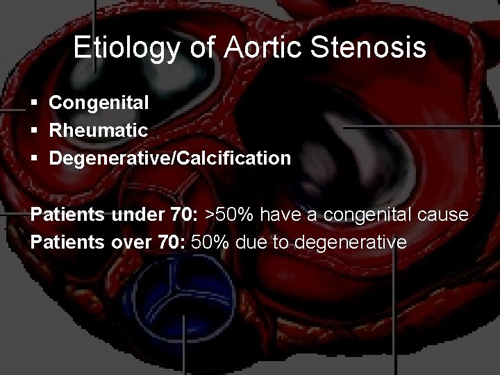 Etiology of Aortic Stenosis § Congenital § Rheumatic § Degenerative/Calcification Patients under 70: >50%