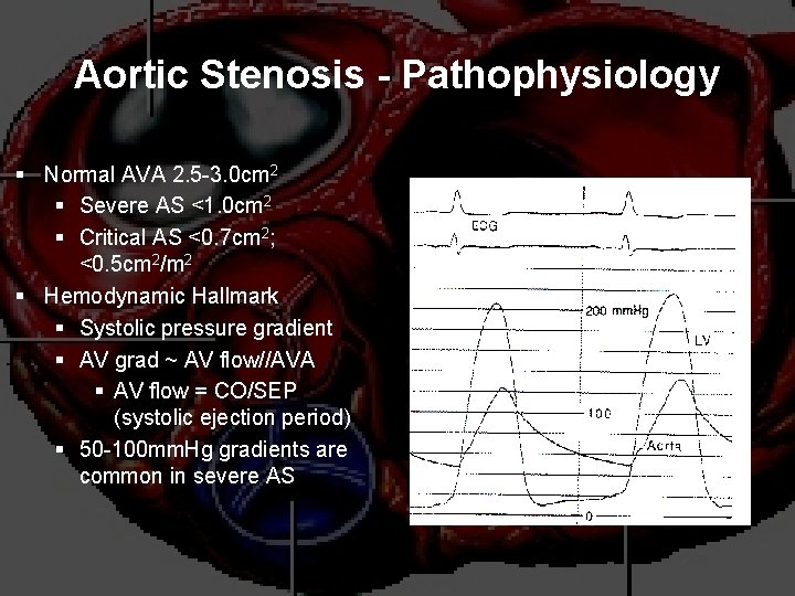 Aortic Stenosis - Pathophysiology § Normal AVA 2. 5 -3. 0 cm 2 §