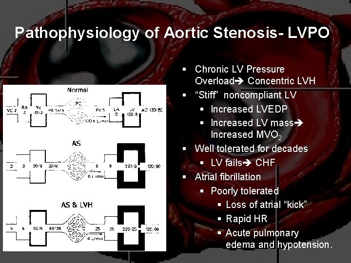 Pathophysiology of Aortic Stenosis- LVPO § Chronic LV Pressure Overload Concentric LVH § “Stiff”