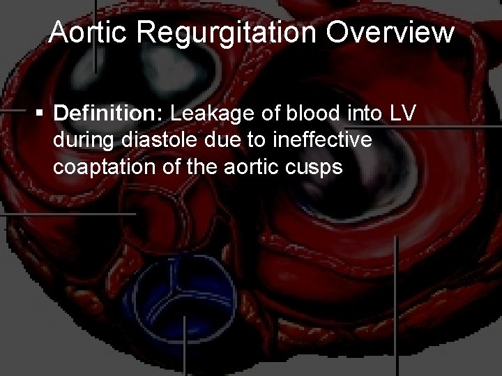 Aortic Regurgitation Overview § Definition: Leakage of blood into LV during diastole due to