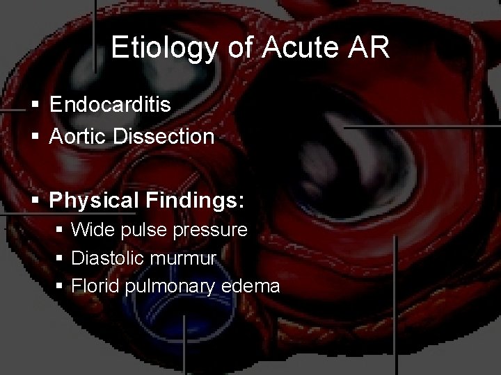 Etiology of Acute AR § Endocarditis § Aortic Dissection § Physical Findings: § Wide