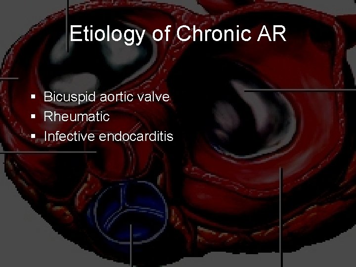 Etiology of Chronic AR § Bicuspid aortic valve § Rheumatic § Infective endocarditis 