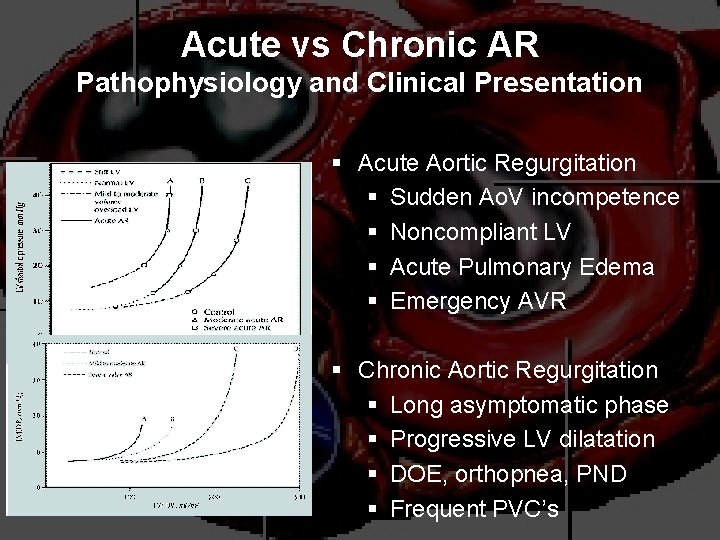 Acute vs Chronic AR Pathophysiology and Clinical Presentation § Acute Aortic Regurgitation § Sudden
