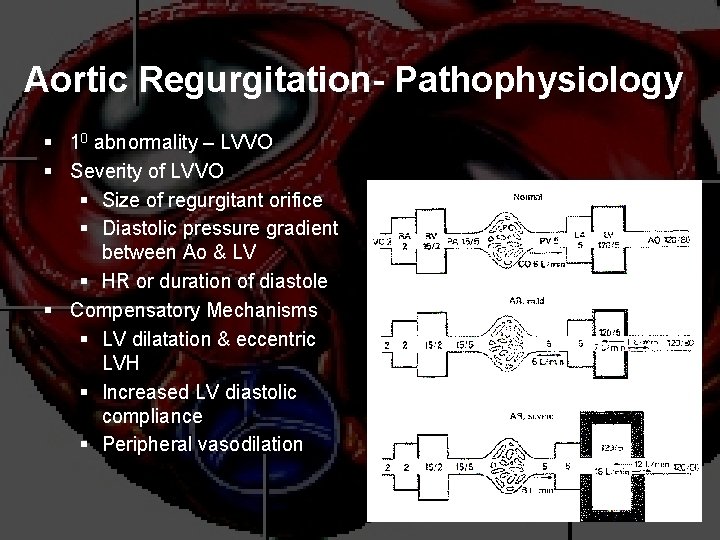 Aortic Regurgitation- Pathophysiology § 10 abnormality – LVVO § Severity of LVVO § Size