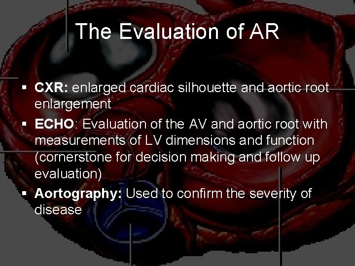 The Evaluation of AR § CXR: enlarged cardiac silhouette and aortic root enlargement §