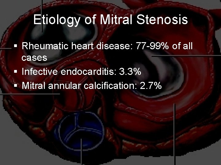 Etiology of Mitral Stenosis § Rheumatic heart disease: 77 -99% of all cases §